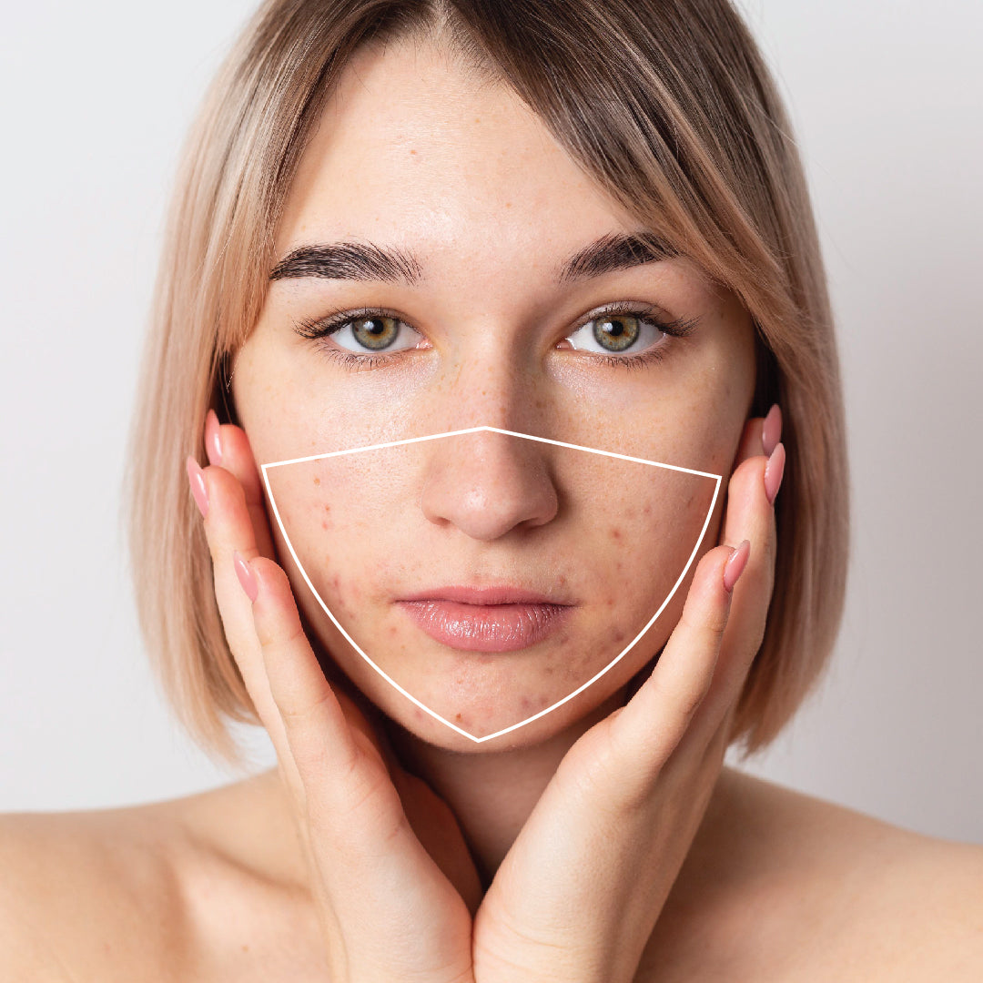 Maskne - What is it and how to avoid it?