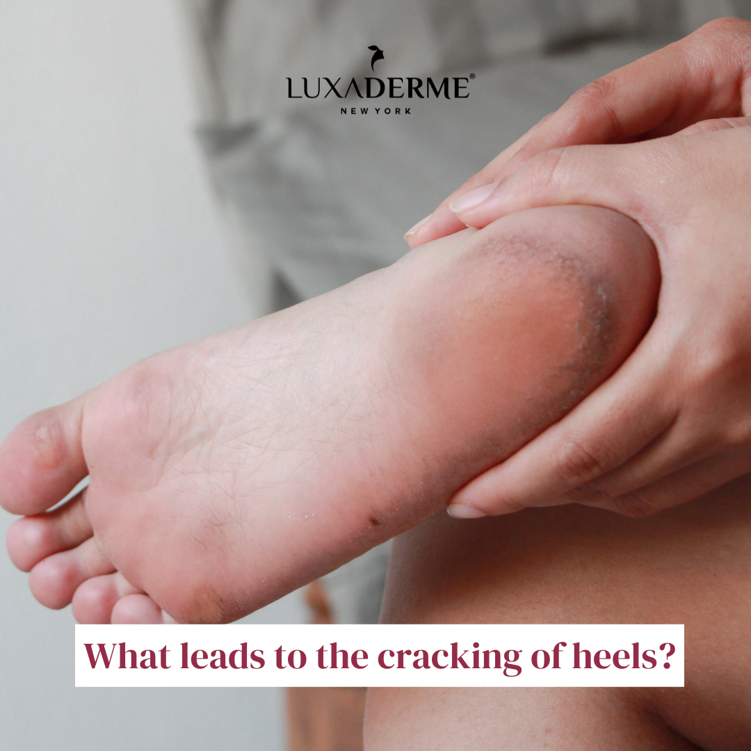 What leads to the cracking of heels?