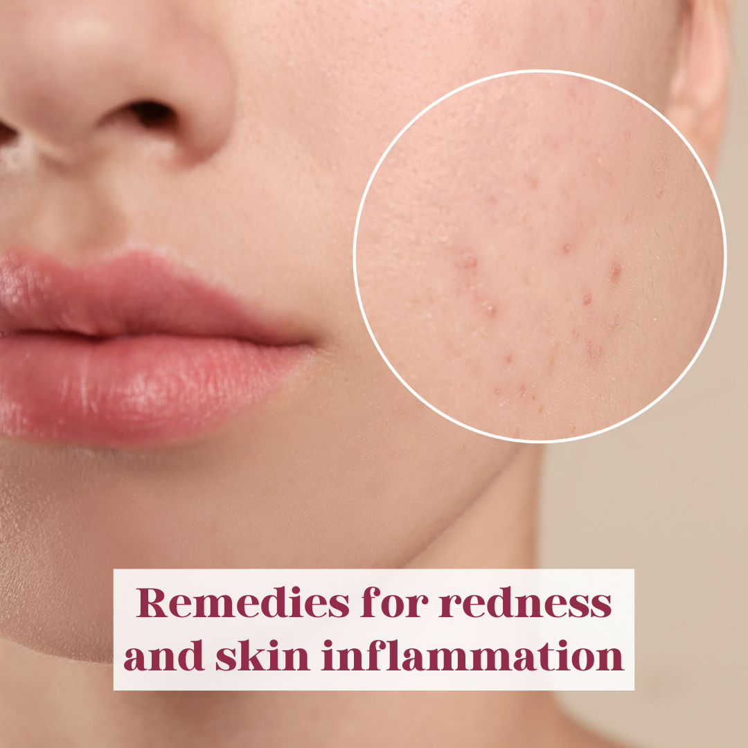 Remedies for redness and skin inflammation